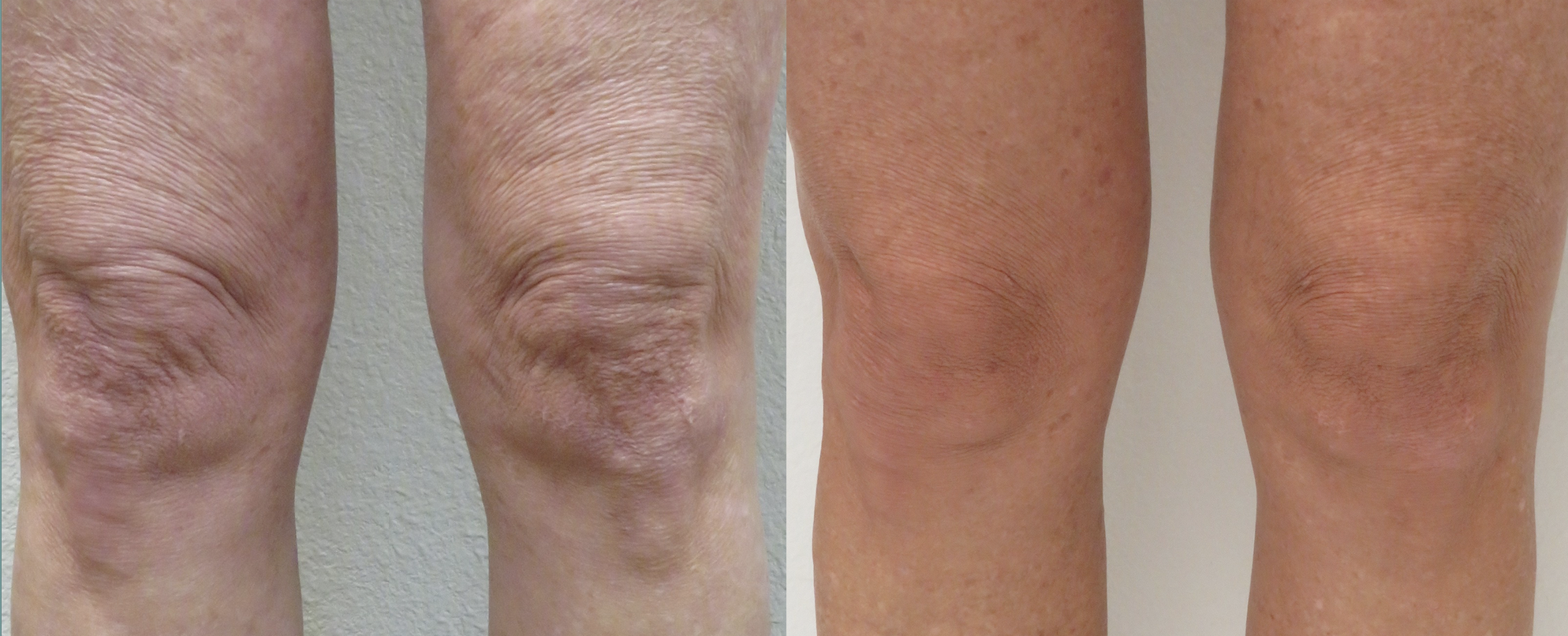 before & after image of a patients knees