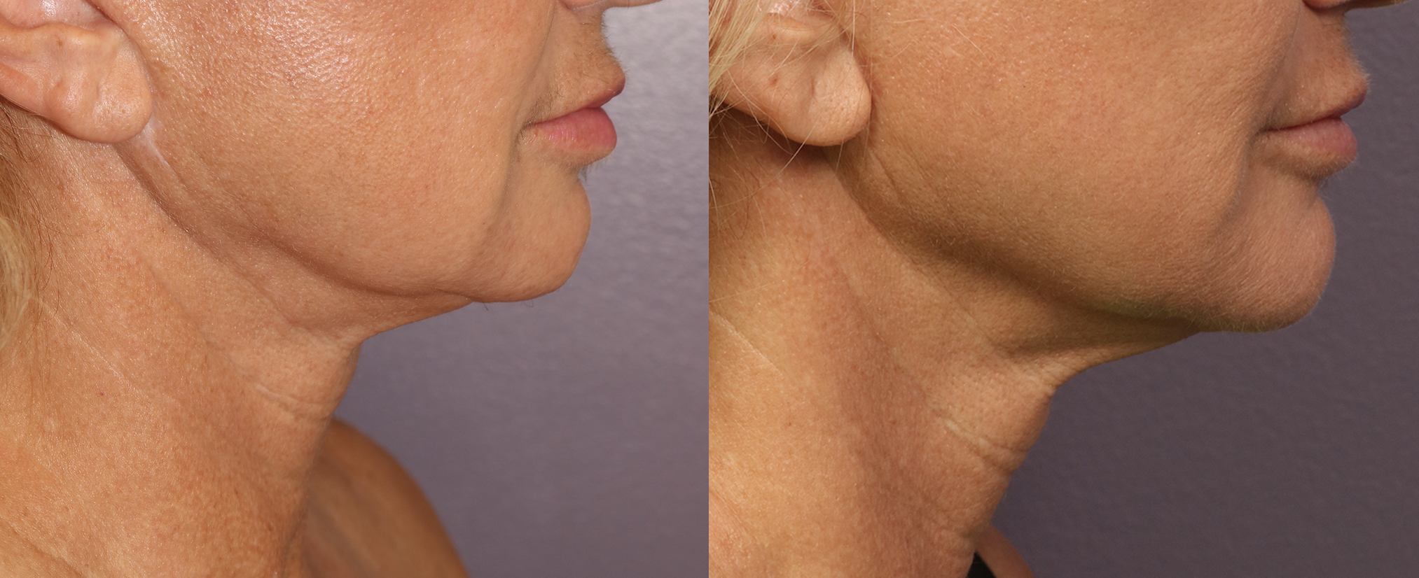 before and after image of a patient's neck after morpheus8 treatment