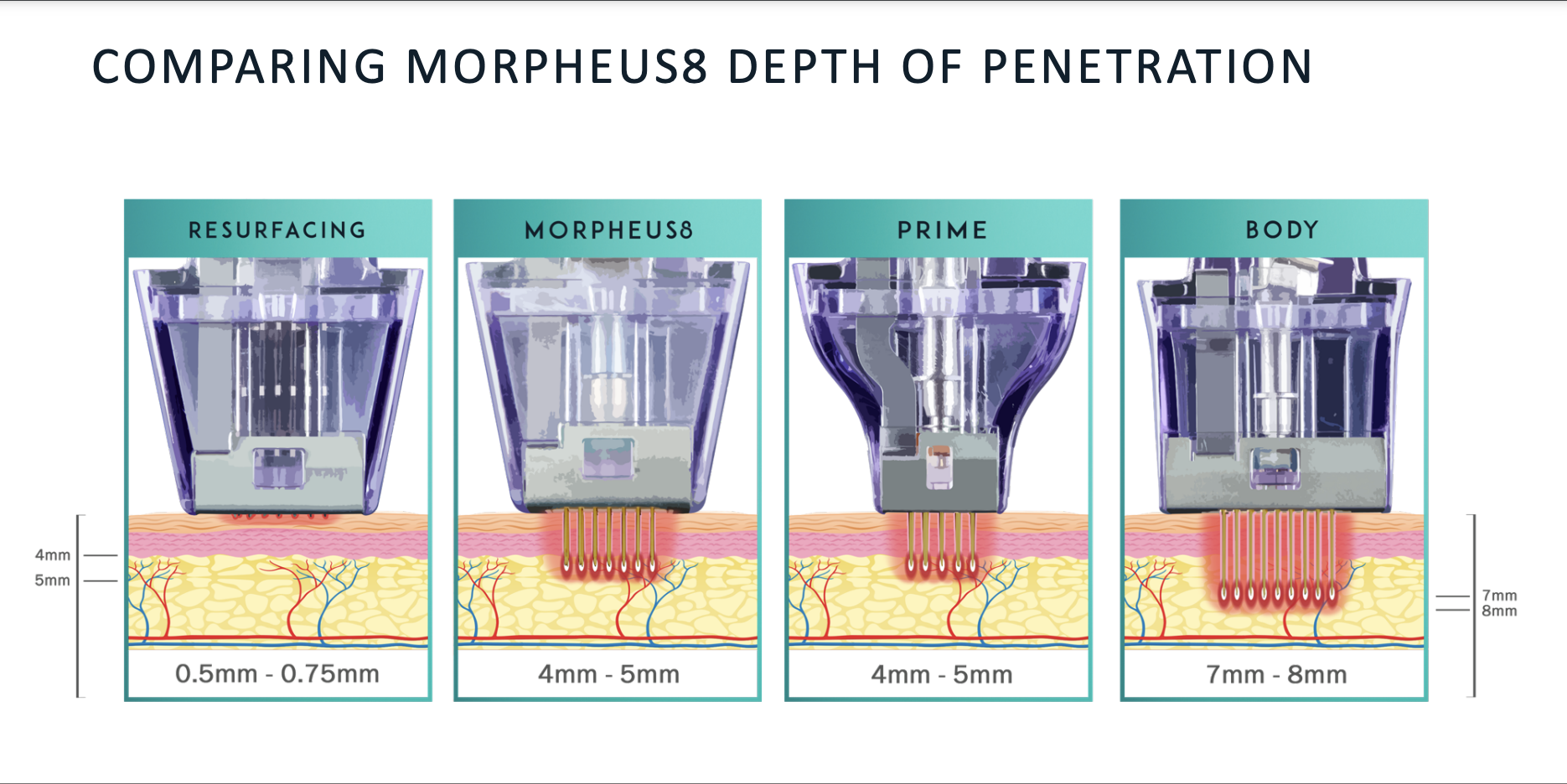 an image showing the different depths of penetration for morpheus8 treatments 