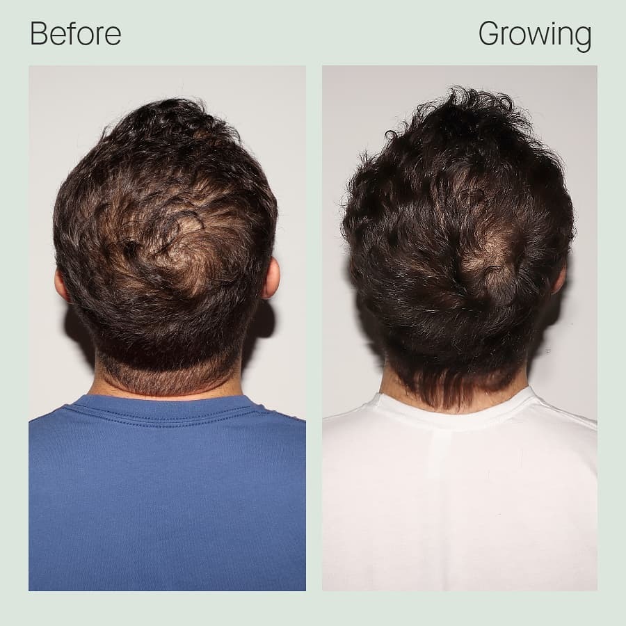 before & after image of male using Nutrafol