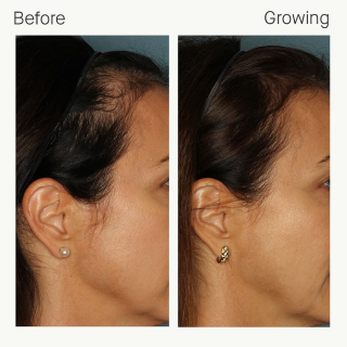 before & after image of female using Nutrafol
