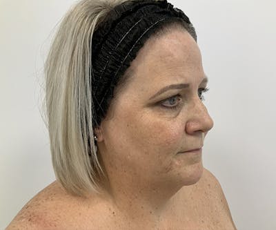 Fillers Before & After Gallery - Patient 121871615 - Image 1