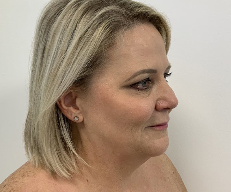 BOTOX  Before & After Gallery - Patient 121871602 - Image 2