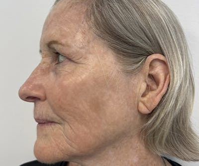 Lumecca™ IPL Photofacial Before & After Gallery - Patient 121871627 - Image 2