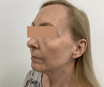 Fillers Gallery - Patient 121871616 - Image 1