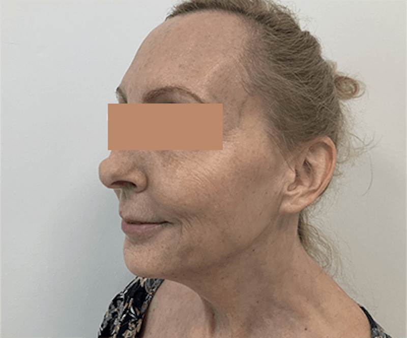 Fillers Gallery - Patient 121871616 - Image 2