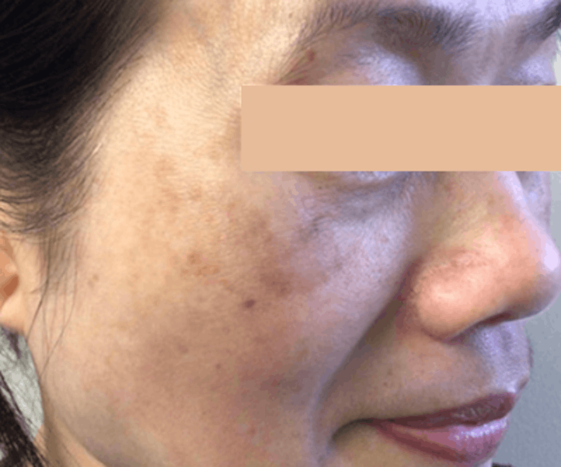 Lumecca™ IPL Photofacial Before & After Gallery - Patient 122403230 - Image 2