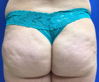 QWO Before & After Gallery - Patient 122403242 - Image 1