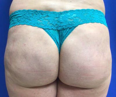 QWO Before & After Gallery - Patient 122403242 - Image 2