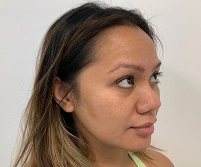 Fillers Before & After Gallery - Patient 122403078 - Image 1