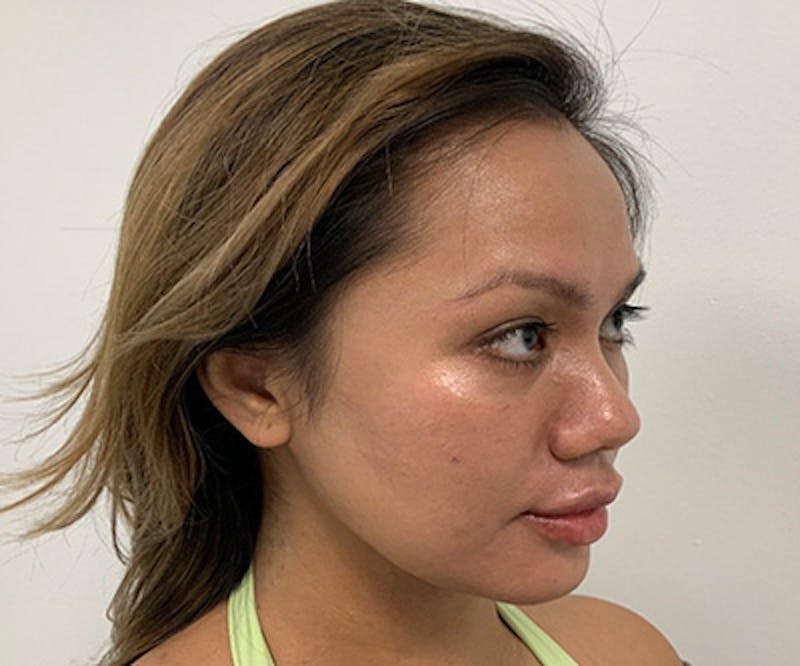 Fillers Before & After Gallery - Patient 122403078 - Image 2