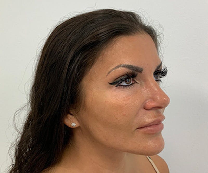 Fillers Gallery - Patient 122403079 - Image 1