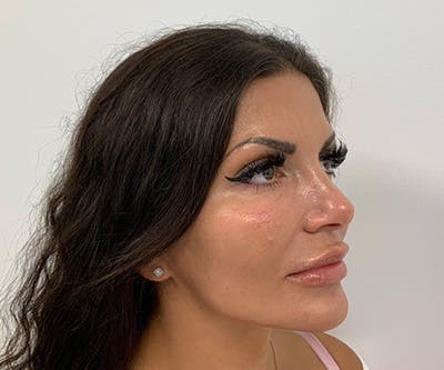 Fillers Before & After Gallery - Patient 122403079 - Image 2