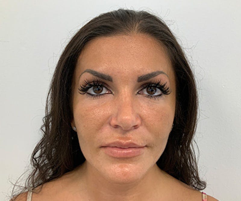 Fillers Before & After Gallery - Patient 122403079 - Image 3