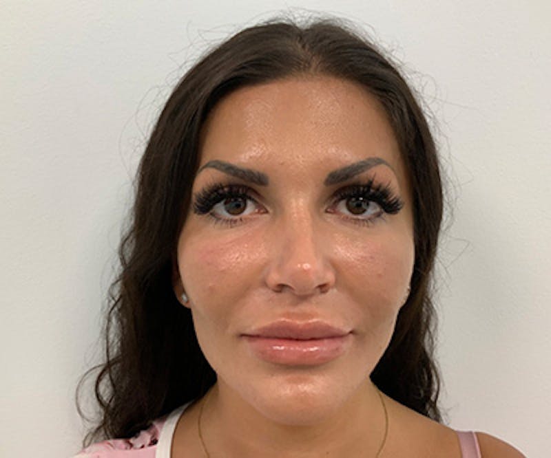Fillers Before & After Gallery - Patient 122403079 - Image 4
