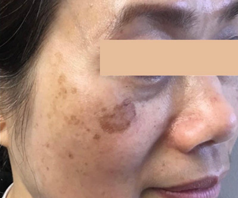 Lumecca™ IPL Photofacial Before & After Gallery - Patient 122403230 - Image 1