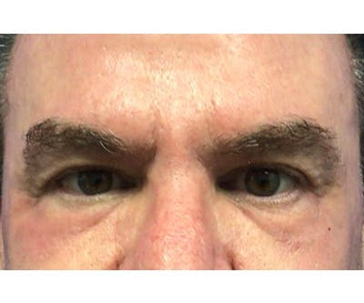 Fillers Before & After Gallery - Patient 122403080 - Image 2