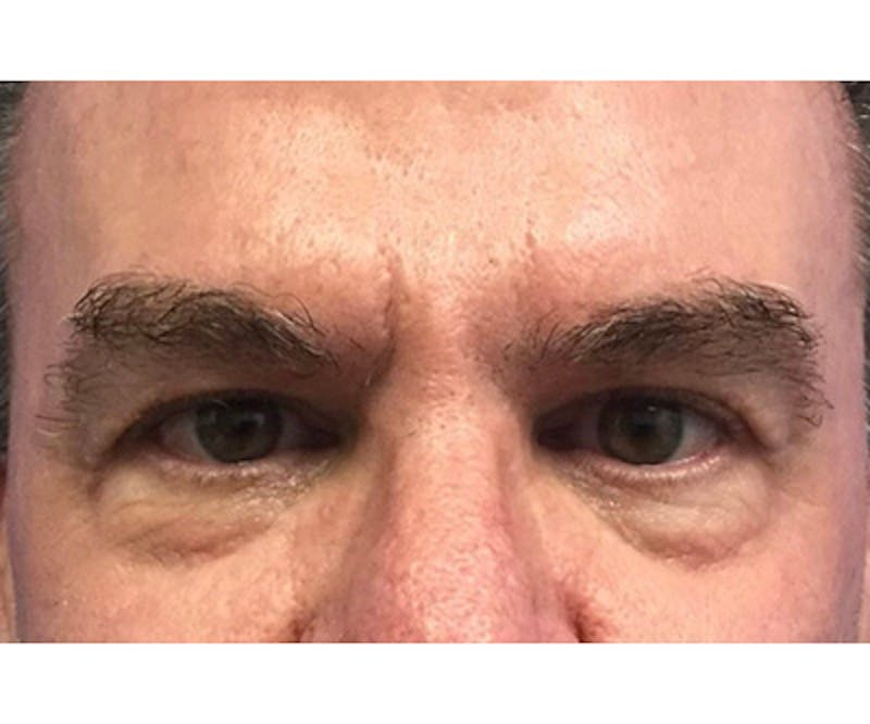 Fillers Before & After Gallery - Patient 122403080 - Image 1