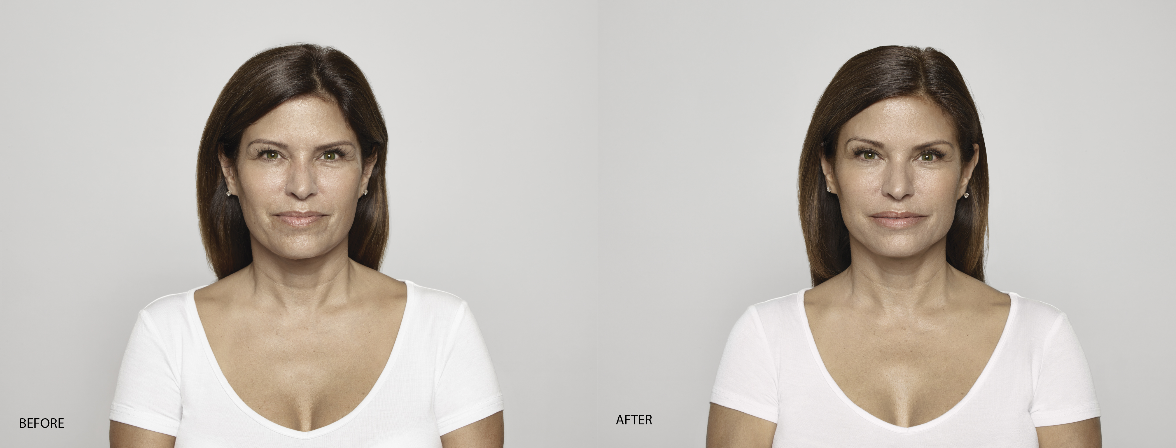 restylane patient before and after