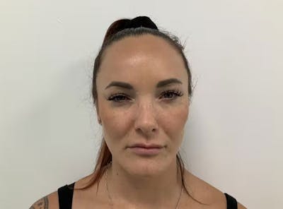BOTOX  Before & After Gallery - Patient 123837373 - Image 2
