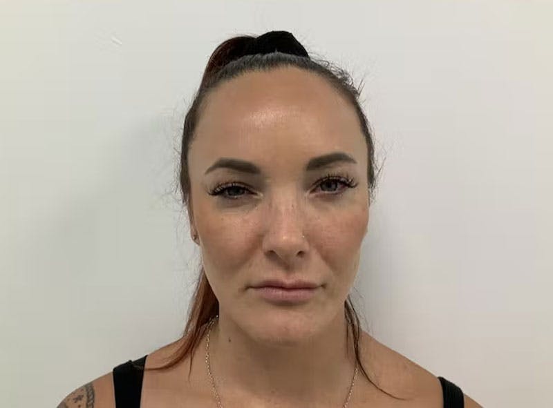 BOTOX  Before & After Gallery - Patient 123837373 - Image 2