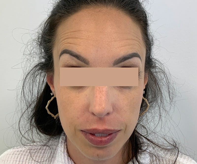BOTOX  Before & After Gallery - Patient 123840948 - Image 1