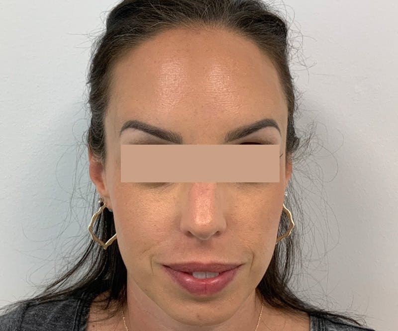 BOTOX  Before & After Gallery - Patient 123840948 - Image 2