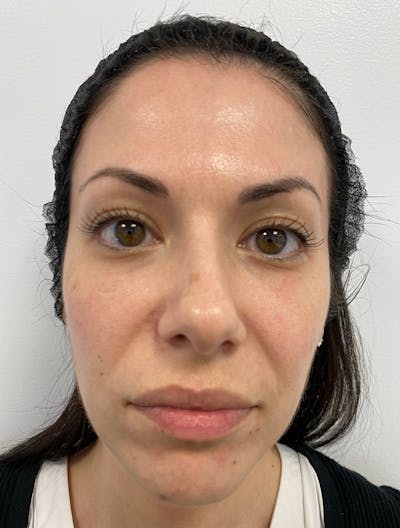 Morpheus8 Before & After Gallery - Patient 123840944 - Image 1