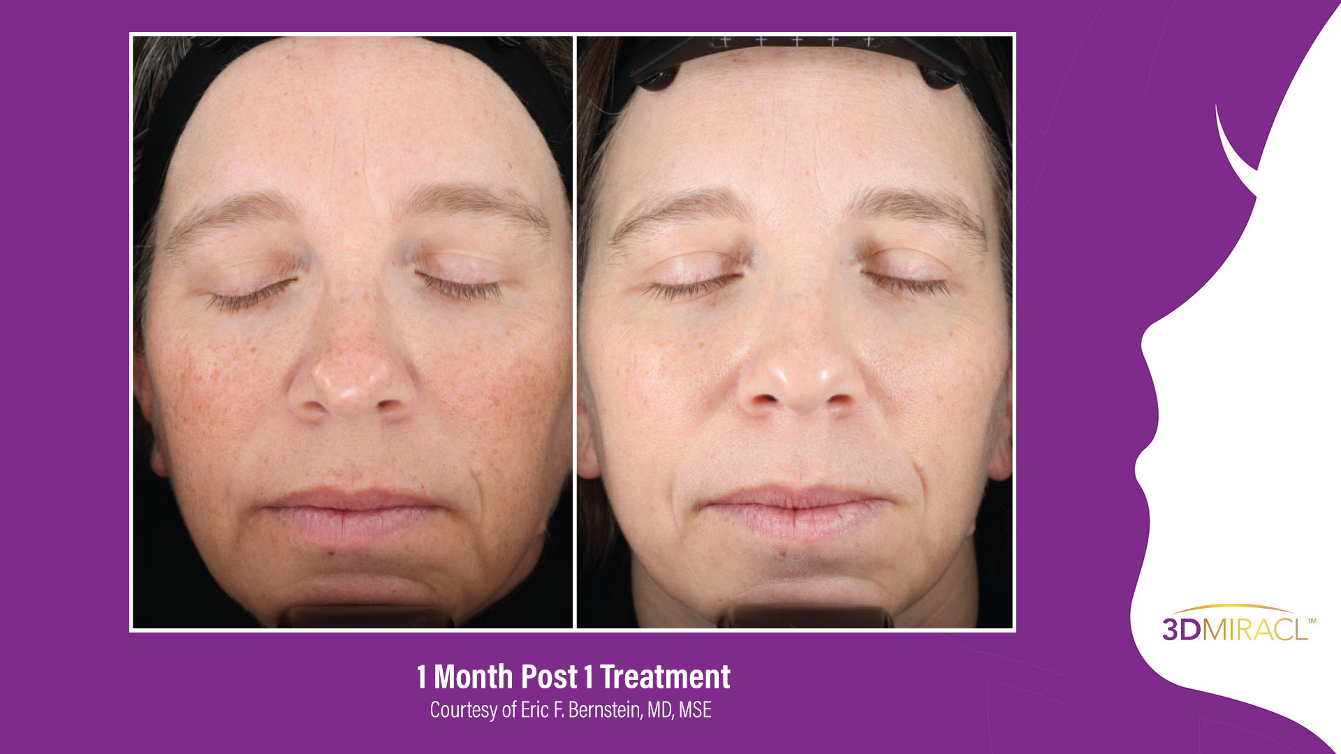 UltraClear Laser Skin Rejuvenation Solutions