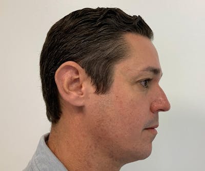 Fillers Before & After Gallery - Patient 144562593 - Image 1
