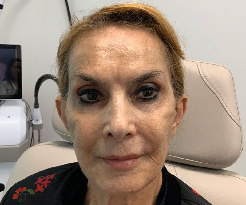 Fillers Before & After Gallery - Patient 144562604 - Image 1