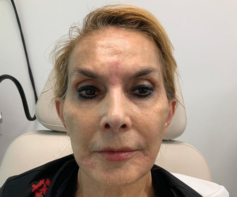 Fillers Before & After Gallery - Patient 144562604 - Image 2