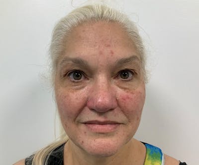 BOTOX  Before & After Gallery - Patient 144562608 - Image 1
