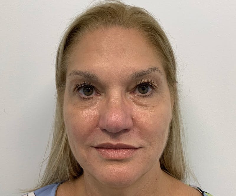 BOTOX  Before & After Gallery - Patient 144562608 - Image 2