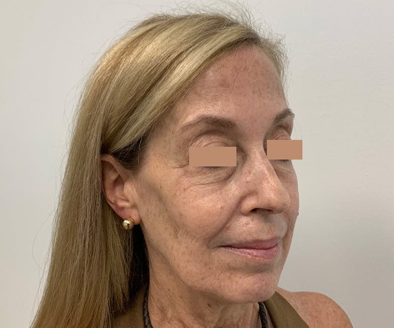 Fillers Before & After Gallery - Patient 144562595 - Image 1