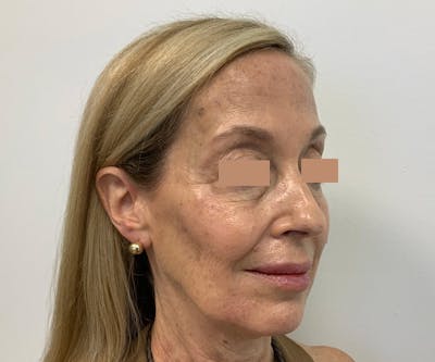 Fillers Before & After Gallery - Patient 144562595 - Image 2