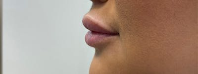 Fillers Before & After Gallery - Patient 144562603 - Image 1