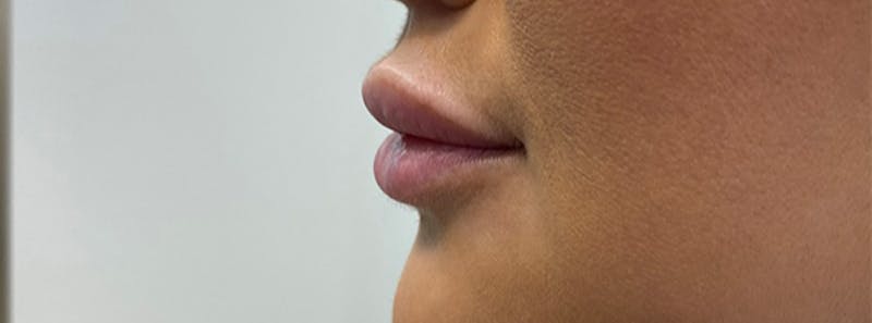 Fillers Before & After Gallery - Patient 144562603 - Image 1