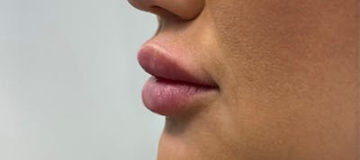Fillers Before & After Gallery - Patient 144562603 - Image 2