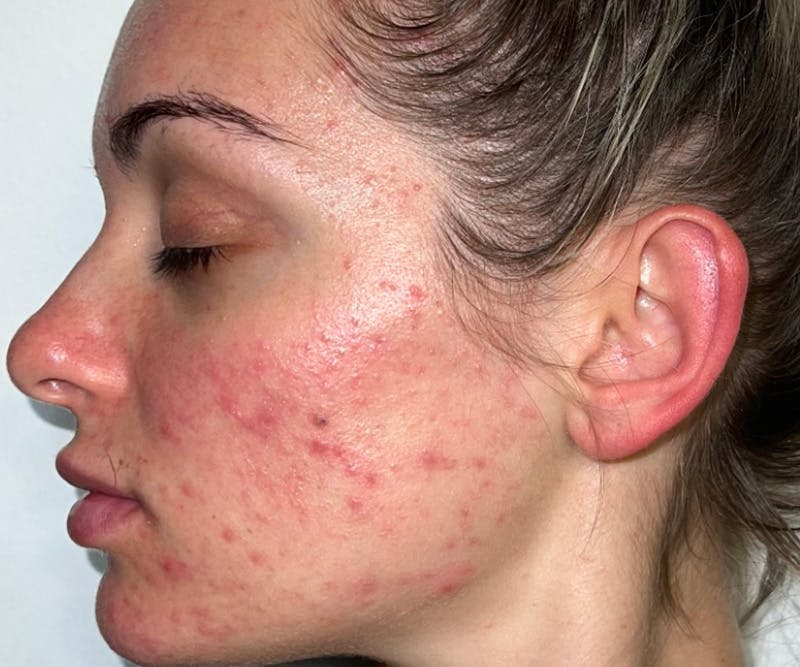 an acne treatment patient before image