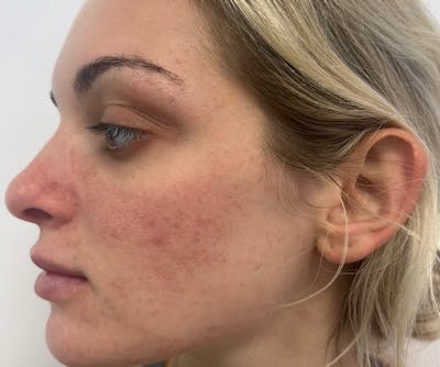 SkinPen® Microneedling Before & After Gallery - Patient 144687298 - Image 2
