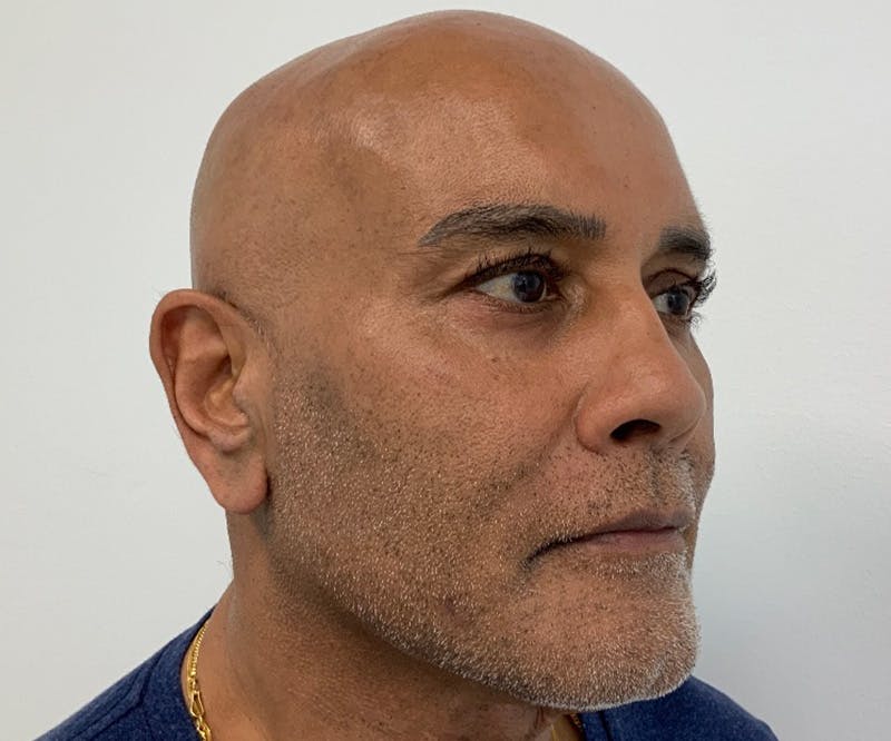 Fillers Before & After Gallery - Patient 144687319 - Image 4