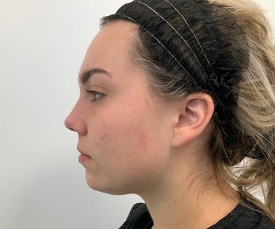 Fillers Before & After Gallery - Patient 148703275 - Image 1