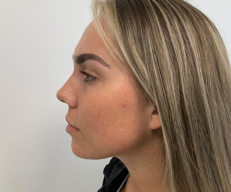 a side profile of a patient before and after