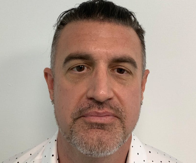 Fillers Before & After Gallery - Patient 148734053 - Image 3