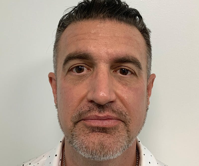 Fillers Before & After Gallery - Patient 148734053 - Image 4