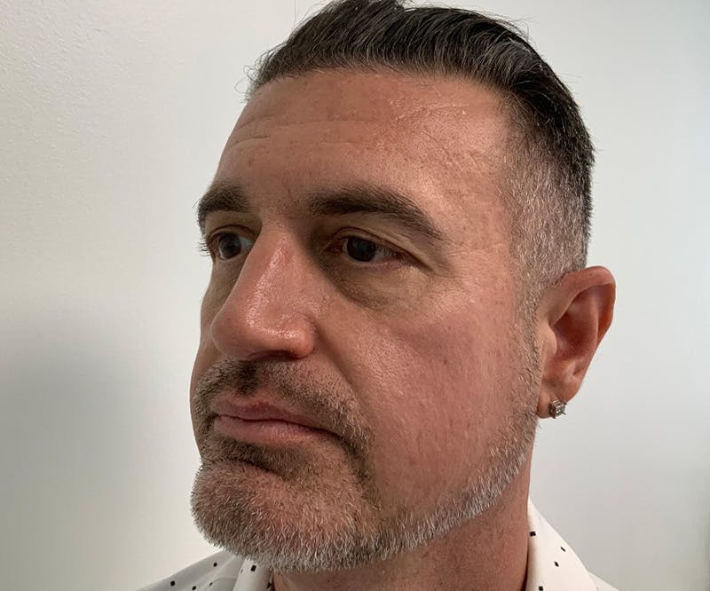 Fillers Before & After Gallery - Patient 148734053 - Image 1
