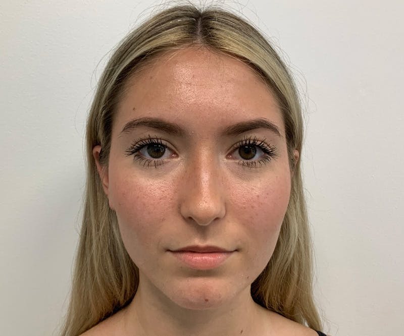 Fillers Before & After Gallery - Patient 148734684 - Image 3
