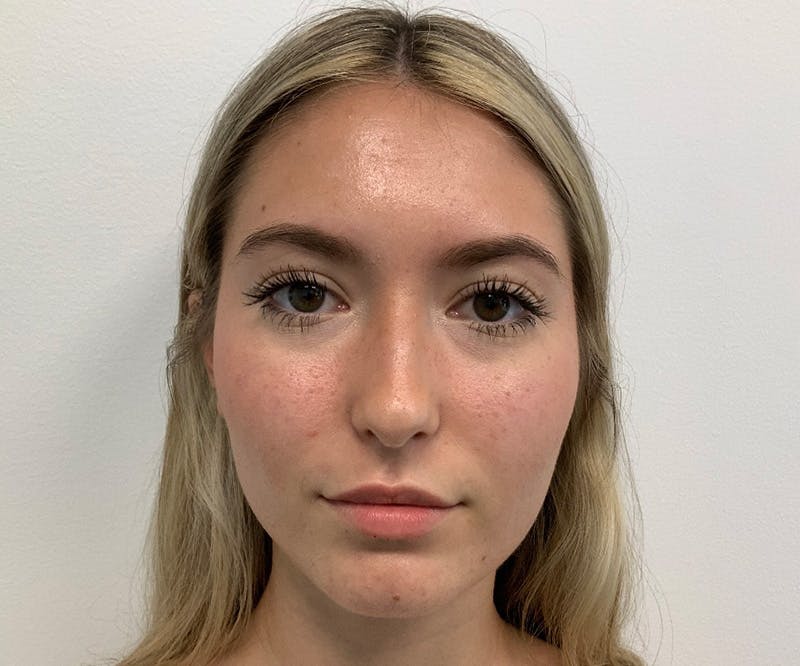 Fillers Before & After Gallery - Patient 148734684 - Image 4