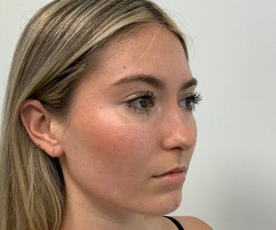 Fillers Before & After Gallery - Patient 148734684 - Image 1